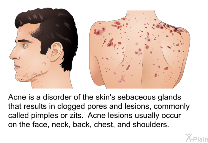Acne is a disorder of the skin's sebaceous glands that results in clogged pores and lesions, commonly called pimples or zits. Acne lesions usually occur on the face, neck, back, chest, and shoulders.