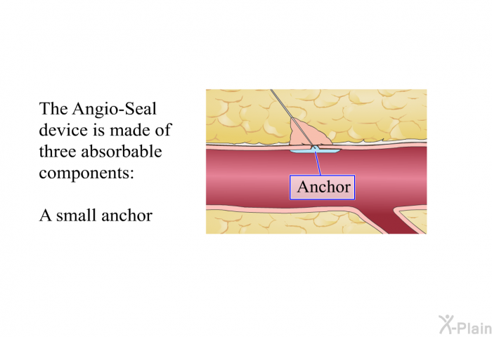 The Angio-Seal device is made of three absorbable components:  A small anchor