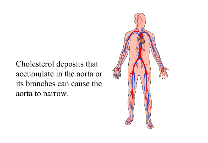 Cholesterol deposits that accumulate in the aorta or its branches can cause the aorta to narrow.