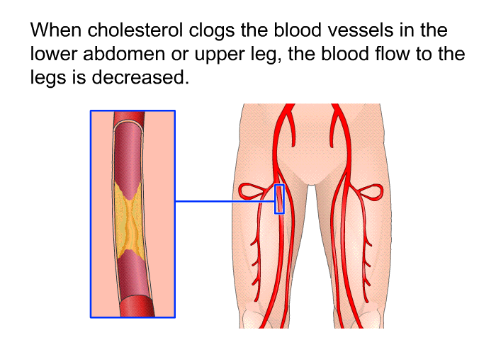 When cholesterol clogs the blood vessels in the lower abdomen or upper leg, the blood flow to the legs is decreased.