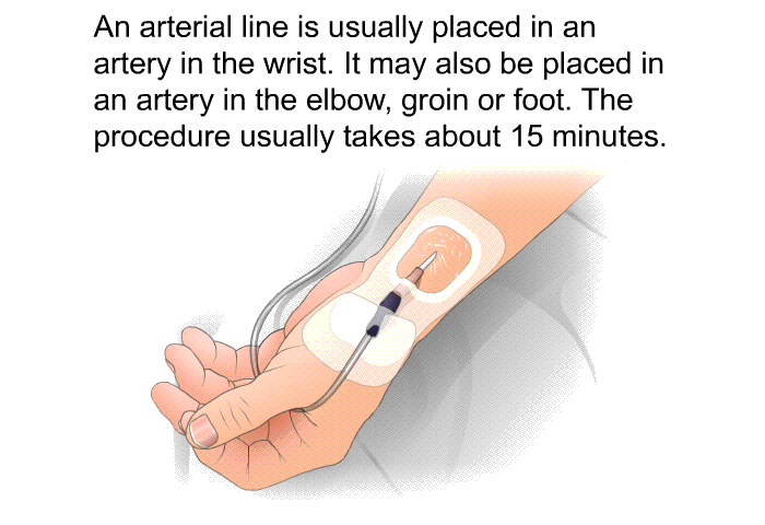 An arterial line is usually placed in an artery in the wrist. It may also be placed in an artery in the elbow, groin or foot. The procedure usually takes about 15 minutes.