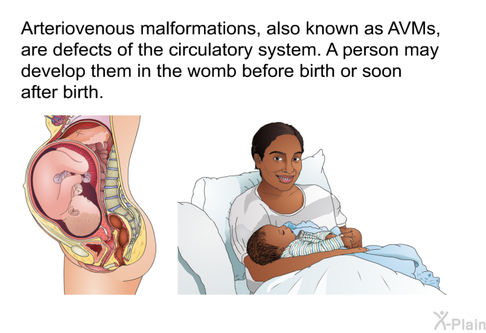 Arteriovenous malformations, also known as AVMs, are defects of the circulatory system. A person may develop them in the womb before birth or soon after birth.