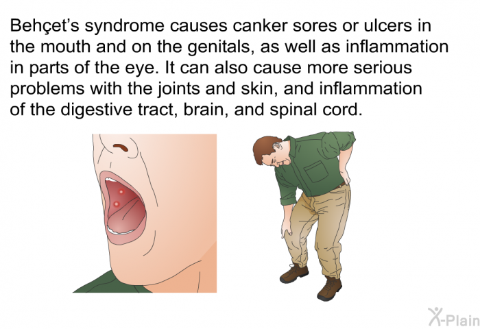 Behçet's syndrome causes canker sores or ulcers in the mouth and on the genitals, as well as inflammation in parts of the eye. It can also cause more serious problems with the joints and skin, and inflammation of the digestive tract, brain, and spinal cord.