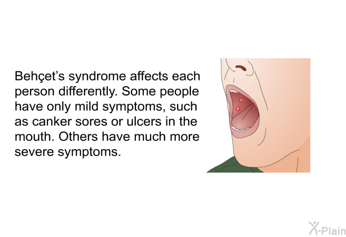 Behçet's syndrome affects each person differently. Some people have only mild symptoms, such as canker sores or ulcers in the mouth. Others have much more severe symptoms.