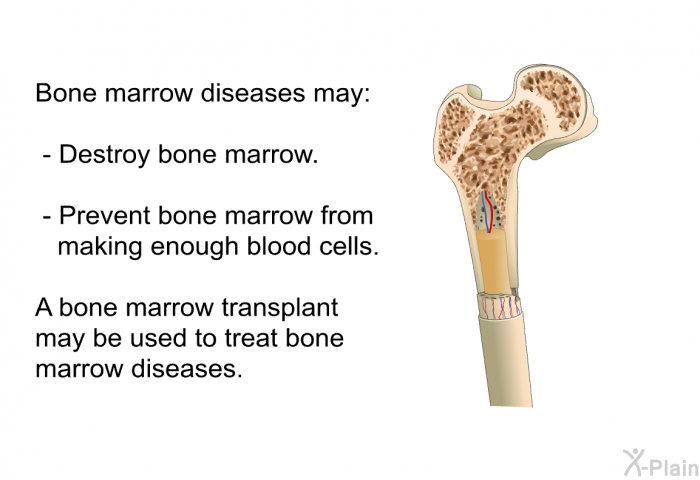 Bone marrow diseases may:  Destroy bone marrow. Prevent bone marrow from making enough blood cells.  
 A bone marrow transplant may be used to treat bone marrow diseases.
