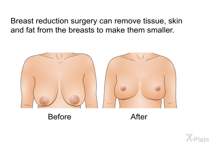 Breast reduction surgery can remove tissue, skin and fat from the breasts to make them smaller.