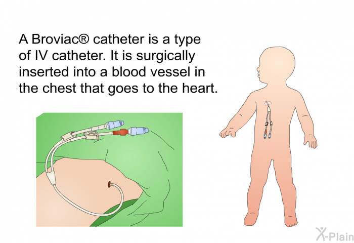 A Broviac  catheter is a type of IV catheter. It is surgically inserted into a blood vessel in the chest that goes to the heart.