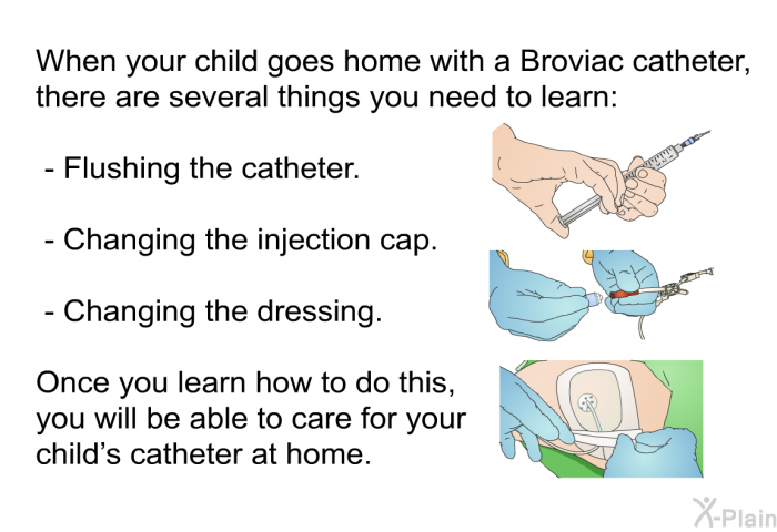 When your child goes home with a Broviac catheter, there are several things you need to learn:  Flushing the catheter. Changing the injection cap. Changing the dressing.  
Once you learn how to do this, you will be able to care for your child’s catheter at home.