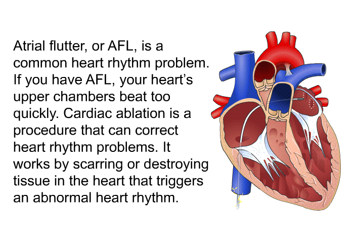 Atrial flutter, or AFL, is a common heart rhythm problem. If you have AFL, your heart's upper chambers beat too quickly. Cardiac ablation is a procedure that can correct heart rhythm problems. It works by scarring or destroying tissue in the heart that triggers an abnormal heart rhythm.