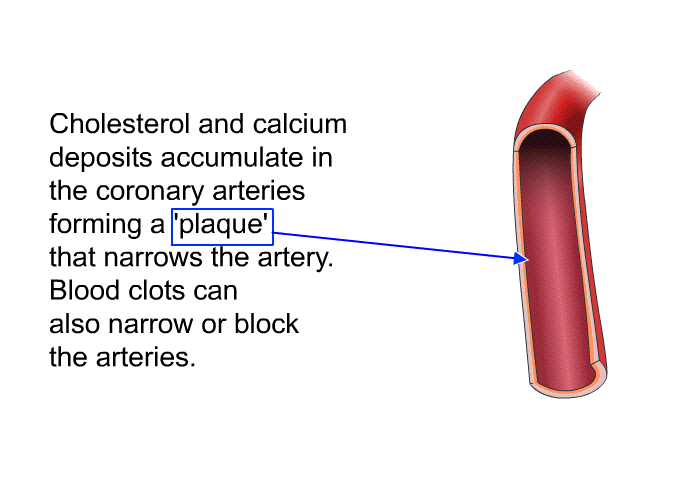 Cholesterol and calcium deposits accumulate in the coronary arteries forming a  plaque' that narrows the artery. Blood clots can also narrow or block the arteries.