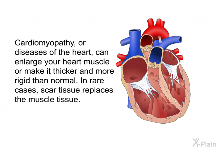 Cardiomyopathy, or diseases of the heart, can enlarge your heart muscle or make it thicker and more rigid than normal. In rare cases, scar tissue replaces the muscle tissue.