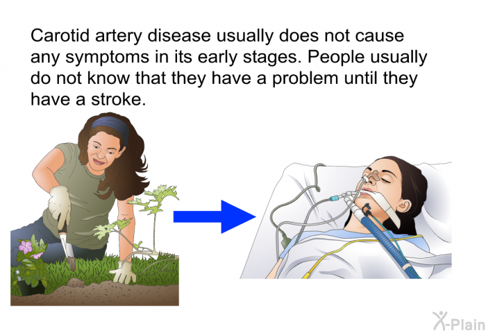 Carotid artery disease usually does not cause any symptoms in its early stages. People usually do not know that they have a problem until they have a stroke.