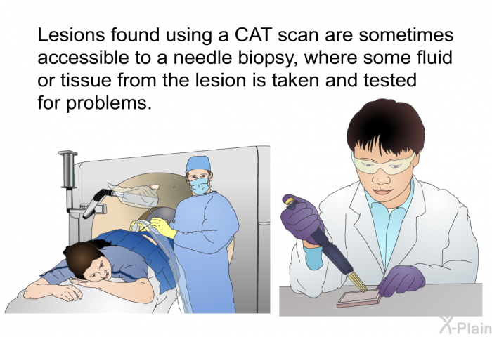 Lesions found using a CAT scan are sometimes accessible to a needle biopsy, where some fluid or tissue from the lesion is taken and tested for problems.