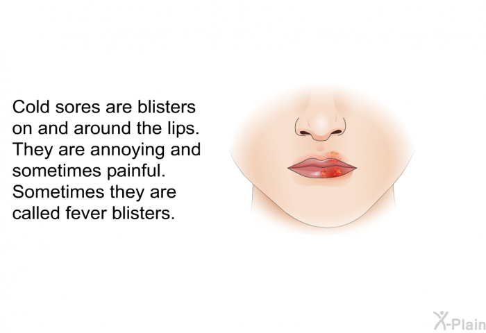Cold sores are blisters on and around the lips. They are annoying and sometimes painful. Sometimes they are called fever blisters.