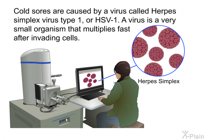 Cold sores are caused by a virus called Herpes simplex virus type 1, or HSV-1. A virus is a very small organism that multiplies fast after invading cells.
