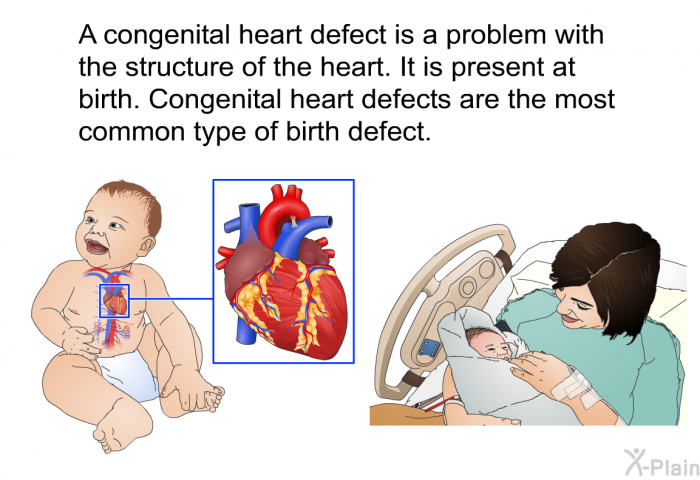 A congenital heart defect is a problem with the structure of the heart. It is present at birth. Congenital heart defects are the most common type of birth defect.