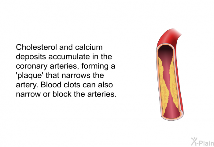 Cholesterol and calcium deposits accumulate in the coronary arteries, forming a 'plaque' that narrows the artery. Blood clots can also narrow or block the arteries.