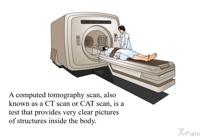 A computed tomography scan, also known as a CT scan or CAT scan, is a test that provides very clear pictures of structures inside the body.