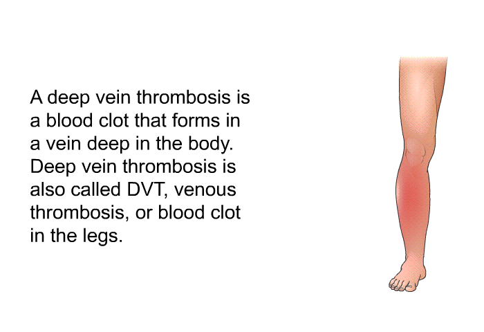 A deep vein thrombosis<B> </B>is a blood clot that forms in a vein deep in the body.<B> </B>Deep vein thrombosis is also called DVT<B>, </B>venous thrombosis, or blood clot in the legs.