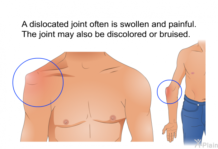 A dislocated joint often is swollen and painful. The joint may also be discolored or bruised.