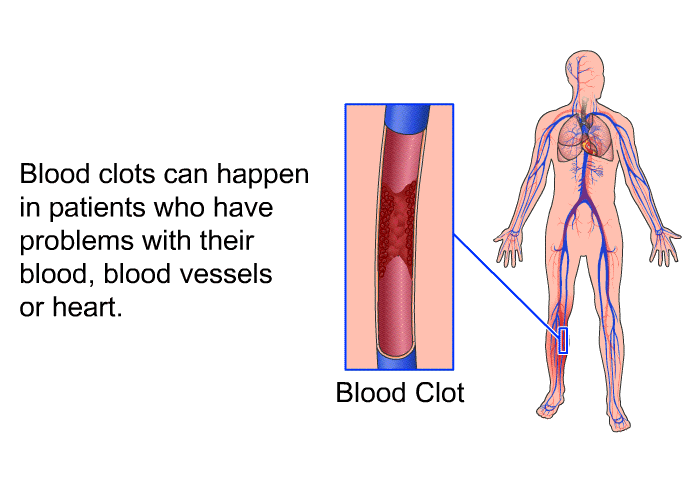 Blood clots can happen in patients who have problems with their blood, blood vessels or heart.