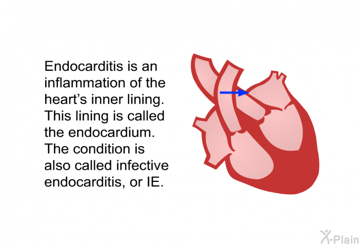 Endocarditis is an inflammation of the heart's inner lining. This lining is called the endocardium. The condition is also called infective endocarditis, or IE.