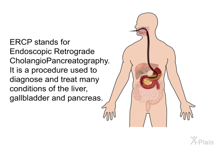 ERCP stands for Endoscopic Retrograde CholangioPancreatography. It is a procedure used to diagnose and treat many conditions of the liver, gallbladder and pancreas.