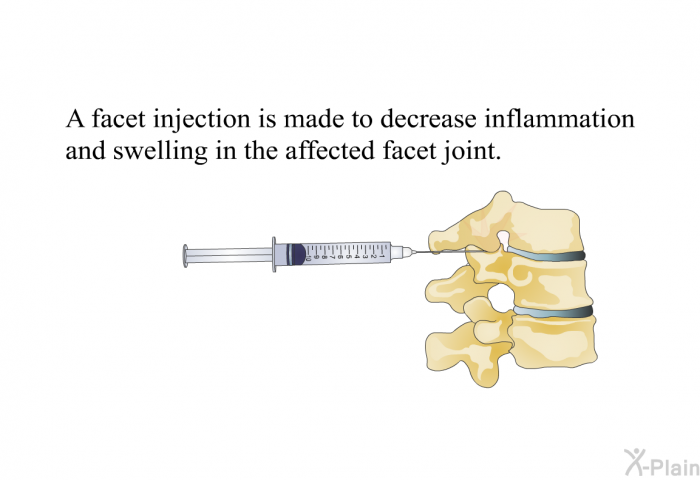 A facet injection is made to decrease inflammation and swelling in the affected facet joint.