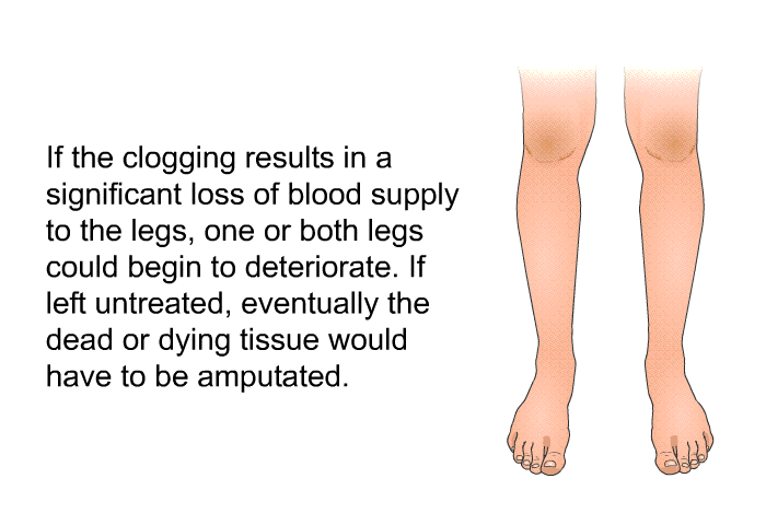 If the clogging results in a significant loss of blood supply to the legs, one or both legs could begin to deteriorate. If left untreated, eventually the dead or dying tissue would have to be amputated.