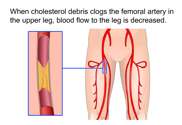 When cholesterol debris clogs the femoral artery in the upper leg, blood flow to the leg is decreased.