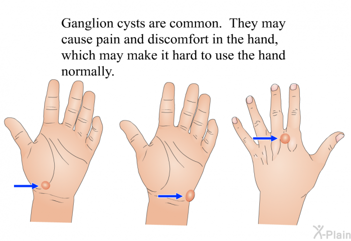 Ganglion cysts are common. They may cause pain and discomfort in the hand, which may make it hard to use the hand normally.