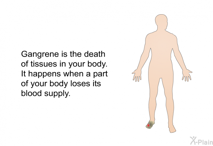 Gangrene is the death of tissues in your body. It happens when a part of your body loses its blood supply.