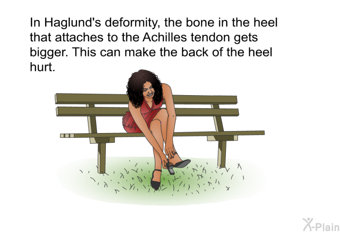 In Haglund's deformity, the bone in the heel that attaches to the Achilles tendon gets bigger. This can make the back of the heel hurt.
