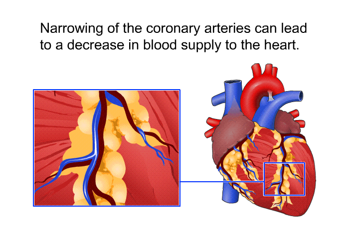 Narrowing of the coronary arteries can lead to a decrease in blood supply to the heart.