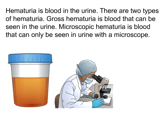 Hematuria is blood in the urine. There are two types of hematuria. Gross hematuria is blood that can be seen in the urine. Microscopic hematuria is blood that can only be seen in urine with a microscope.