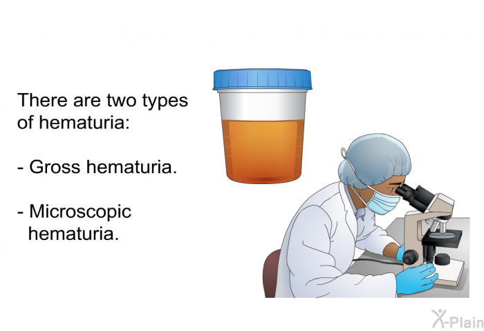 There are two types of hematuria:  Gross hematuria. Microscopic hematuria.