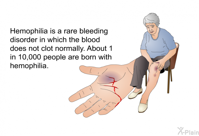 Hemophilia is a rare bleeding disorder in which the blood does not clot normally. About 1 in 10,000 people are born with hemophilia.