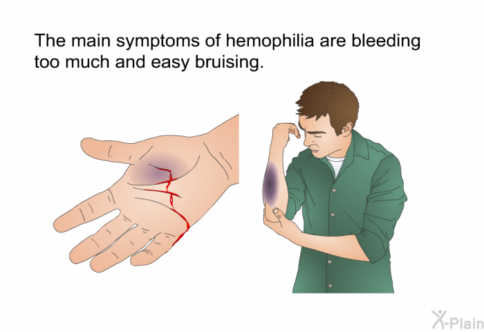 The main symptoms of hemophilia are bleeding too much and easy bruising.