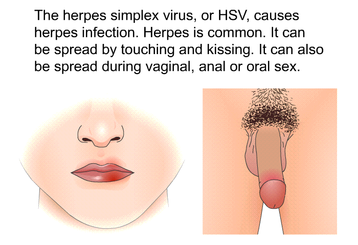 The herpes simplex virus, or HSV, causes herpes infection. Herpes is common. It can be spread by touching and kissing. It can also be spread during vaginal, anal or oral sex.