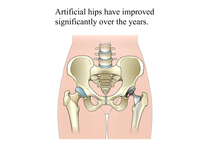 Artificial hips have improved significantly over the years.