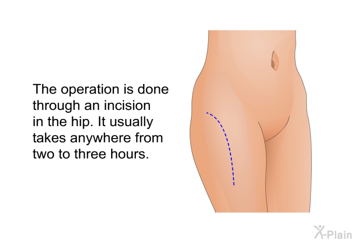 The operation is done through an incision in the hip. It usually takes anywhere from two to three hours.