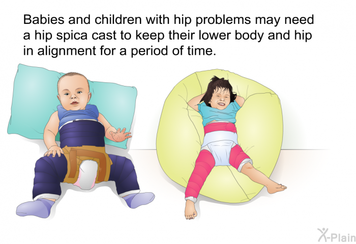 Babies and children with hip problems may need a hip spica cast to keep their lower body and hip in alignment for a period of time.