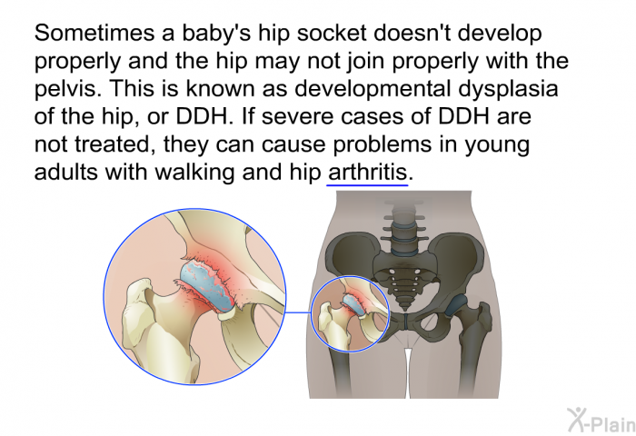 Sometimes a baby's hip socket doesn't develop properly and the hip may not join properly with the pelvis. This is known as developmental dysplasia of the hip, or DDH. If severe cases of DDH are not treated, they can cause problems in young adults with walking and hip arthritis.