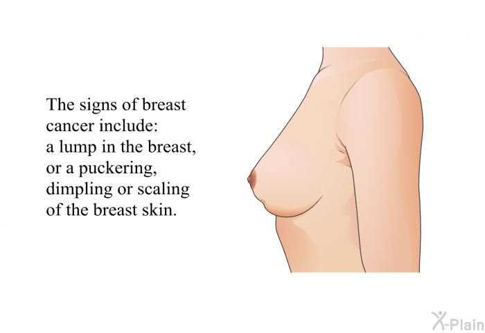 The signs of breast cancer include a lump in the breast, or a puckering, dimpling or scaling of the breast skin.