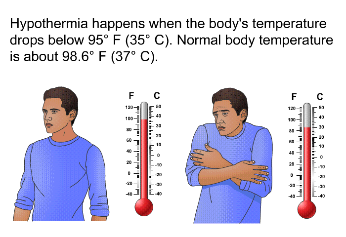 Hypothermia happens when the body's temperature drops below 95° F (35° C). Normal body temperature is about 98.6° F (37° C).