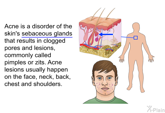 Acne is a disorder of the skin's sebaceous glands that results in clogged pores and lesions, commonly called pimples or zits. Acne lesions usually happen on the face, neck, back, chest and shoulders.