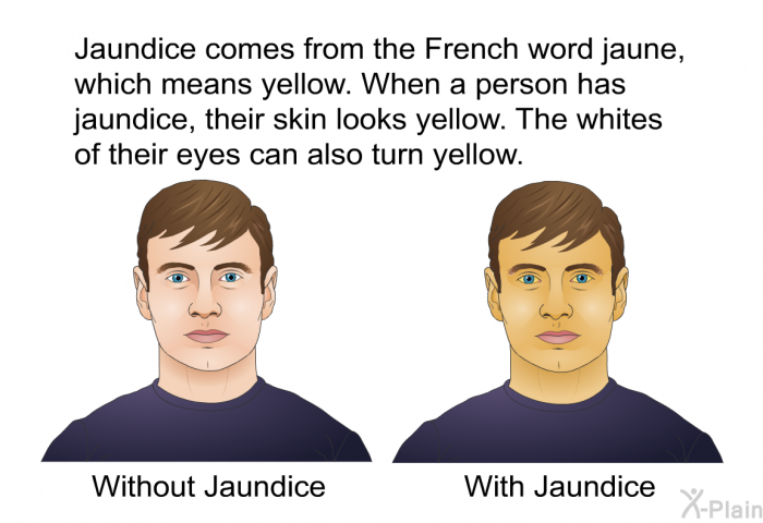 Jaundice comes from the French word jaune, which means yellow. When a person has jaundice, their skin looks yellow. The whites of their eyes can also turn yellow.