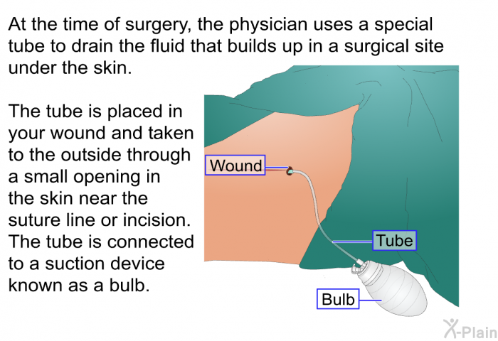 At the time of surgery, the physician uses a special tube to drain the fluid that builds up in a surgical site under the skin. The tube is placed in your wound and taken to the outside through a small opening in the skin near the suture line or incision. The tube is connected to a suction device known as a bulb<B>.</B>