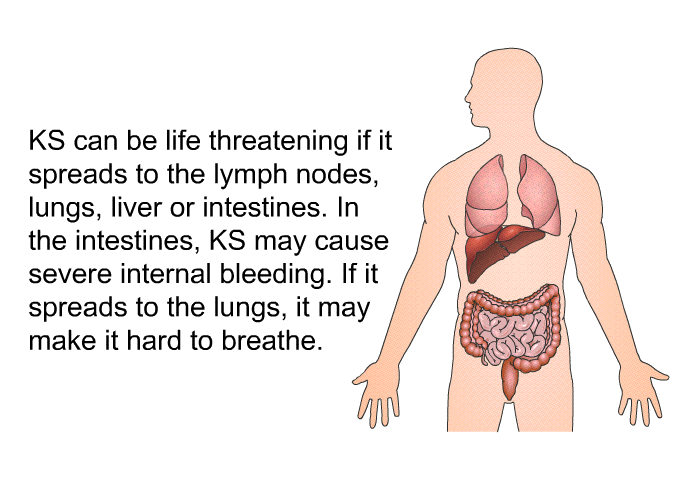KS can be life threatening if it spreads to the lymph nodes, lungs, liver or intestines. In the intestines, KS may cause severe internal bleeding. If it spreads to the lungs, it may make it hard to breathe.