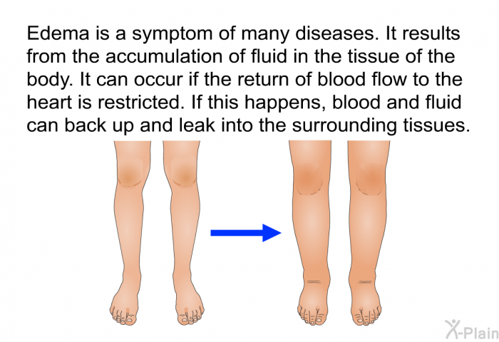 Edema is a symptom of many diseases. It results from the accumulation of fluid in the tissue of the body. It can happen if the return of blood flow to the heart is restricted. If this happens, blood and fluid can back up and leak into the surrounding tissues.